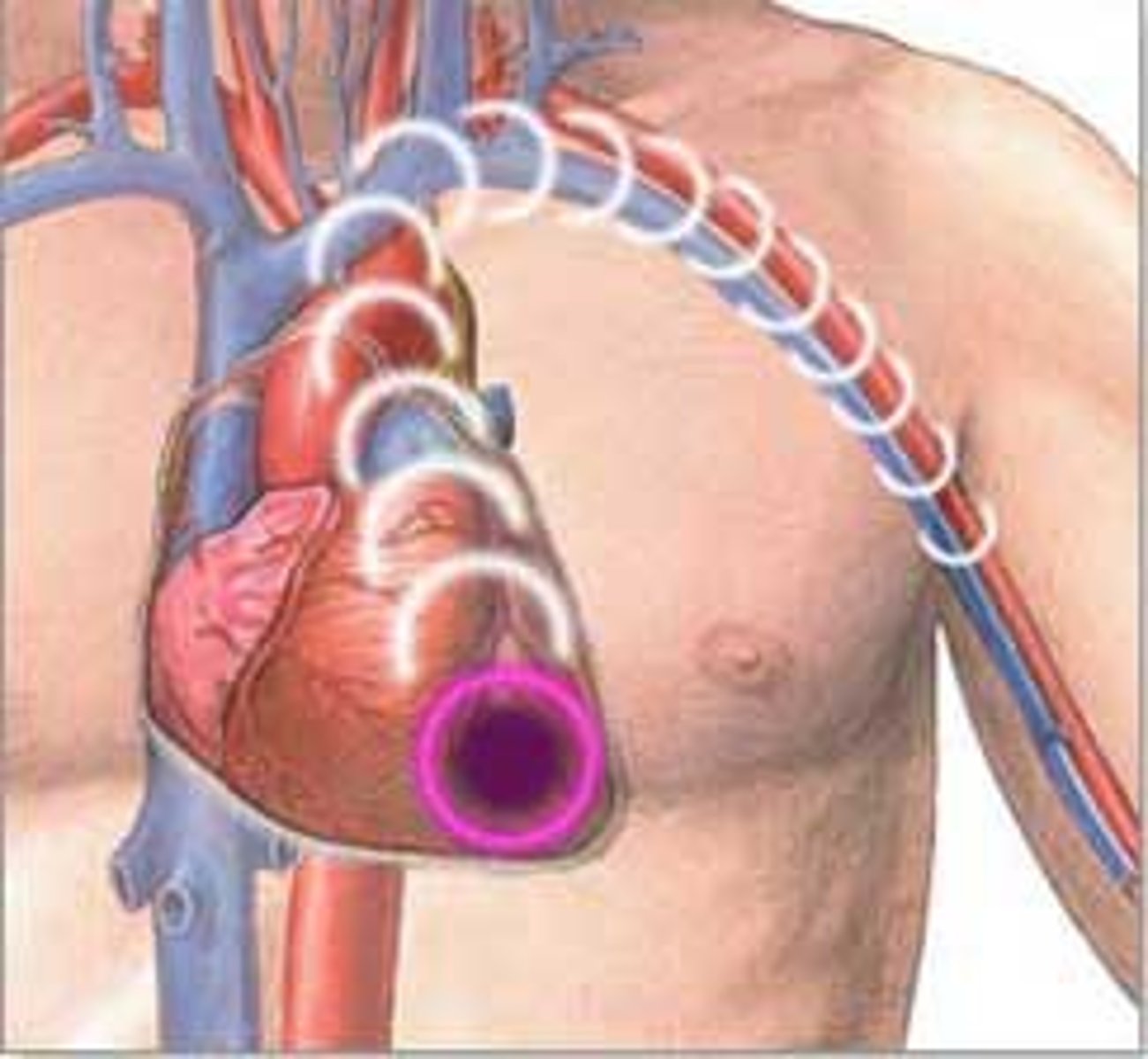<p>when an area of the heart muscle suffers damage and loses function due to lack of oxygen. The heart stops beating</p>