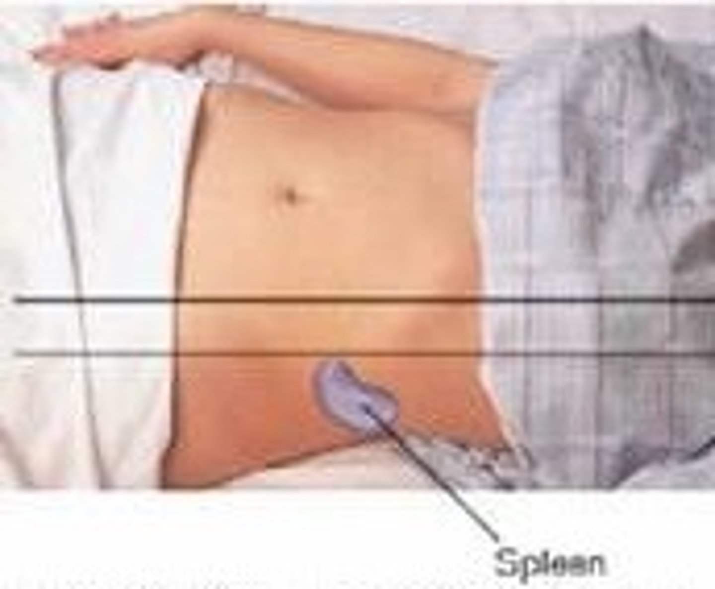 <p>Percuss the lowest interspace in the left anterior axillary line. This area is usually tympanitic. Then have the patient take a deep breath and percuss again. IF the spleen is normal in size the percussion remains tympanitic. Shifting from tympany to dullness with inspiration suggest an enlarged spleen</p>