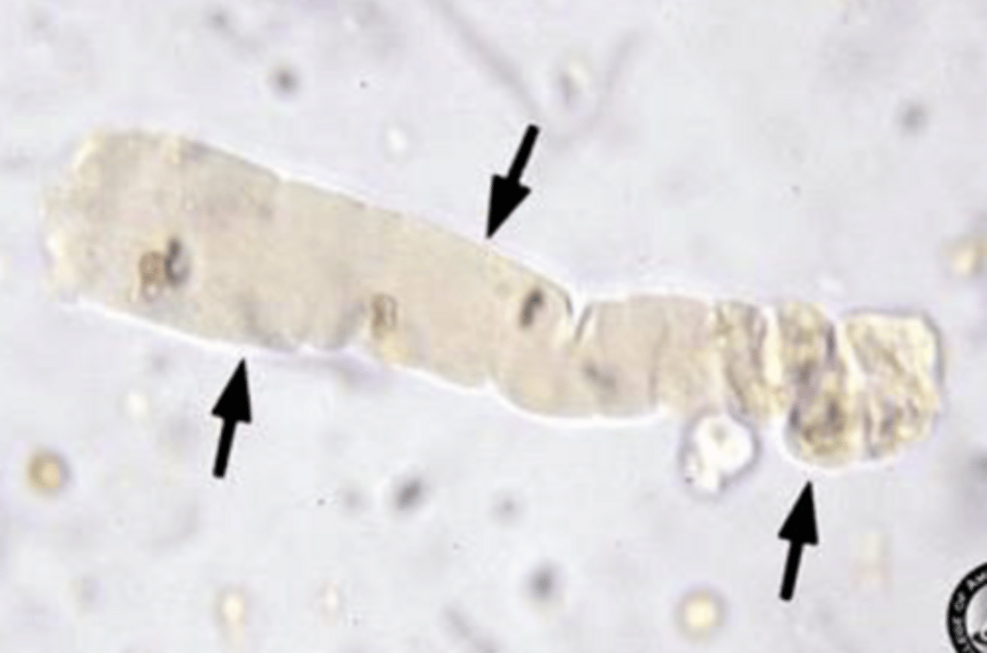 <p>- Last stage in degeneration process</p><p>- Does not have parallel sides</p><p>- Broken, craters</p><p>- Edges more blunt</p><p>- Wider than hyaline</p><p>- Indicates severe damage to renal tubules</p>