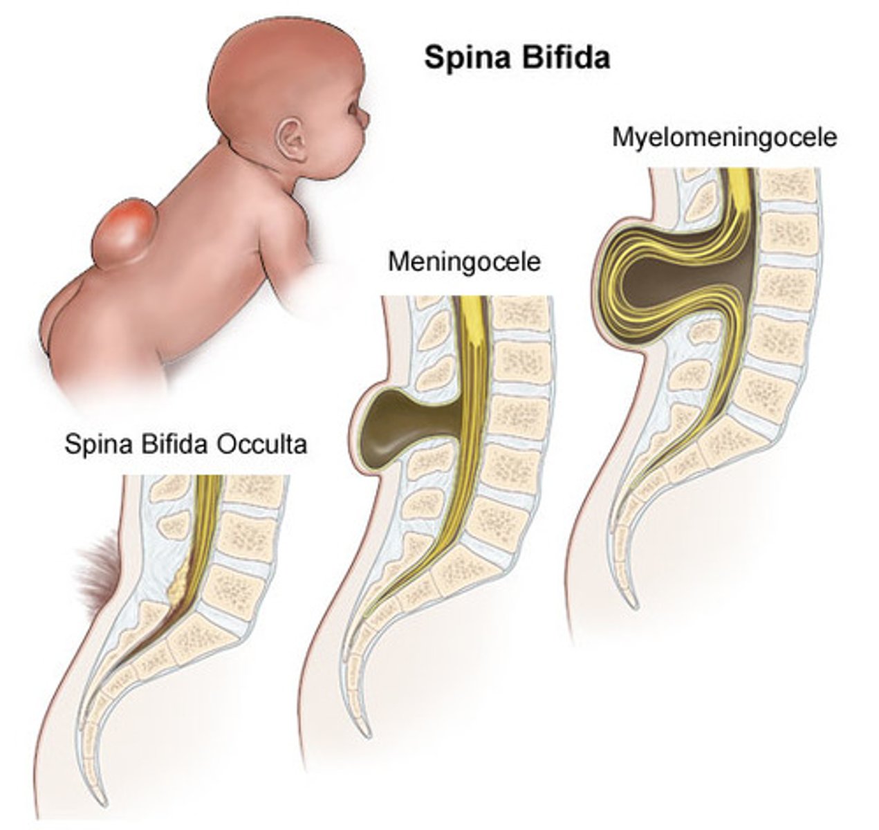 <p>-3.5 in every 10,000 babies (in US)<br>-impacts spinal column/doesn't form properly<br>-typically apparent at birth<br>-Myelomeningocele sack on back exposing nerves (see pic)</p>