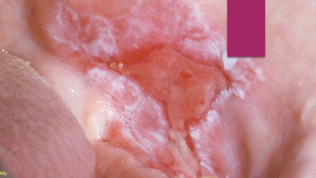 <p>Does erosive lichen planus have a uniform presentation?</p>