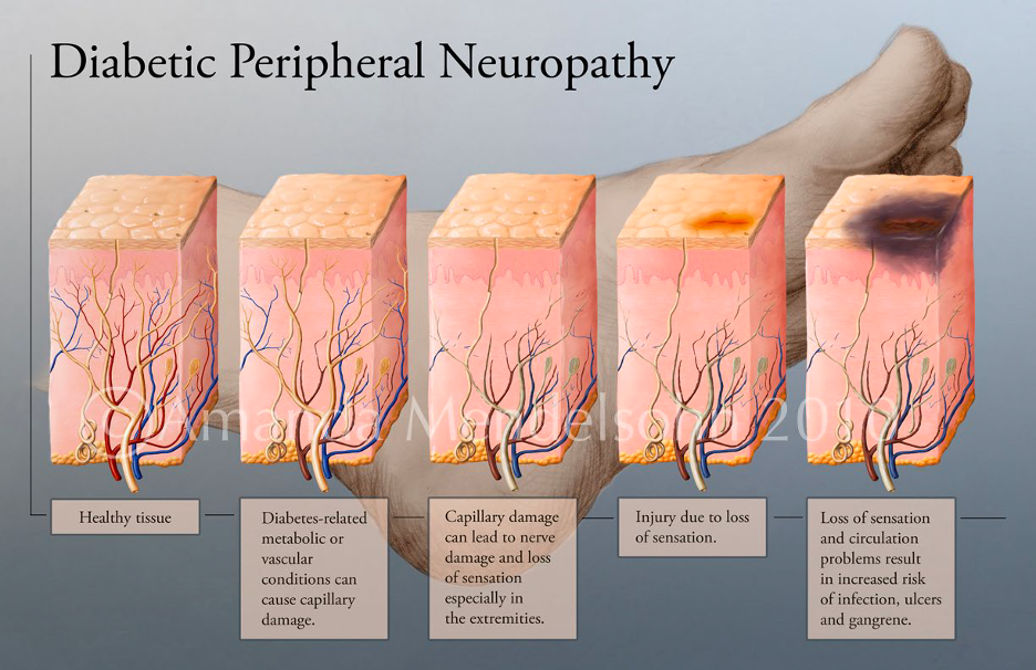 how does diabetic peripheral neuropathy damage tissue