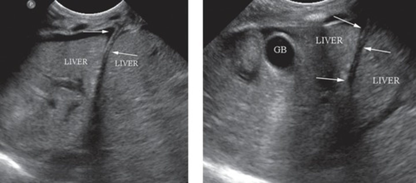 <p>Abdominal contents enter thorax</p><p>Congenital issue</p>