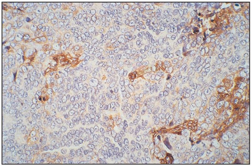 <p>The figure shown is a light micrograph of a tumor section that has been stained to identify the expression of HLA class I. Brown staining is indicative of the presence of HLA class I molecules. As noted by the relatively limited amount of brown staining, this micrograph shows how tumors can lose the expression of HLA class I.</p><p>What are the implications of this result for the immune response against the tumor?</p><p></p><p>a. Tumor cells are resistant to T-cell attack.</p><p>b. Tumor cells are susceptible to anti-tumor antibody.</p><p>c. Tumor cells are susceptible to NK-cell attack.</p><p>d. Tumor cells have enhanced Treg activation ability.</p>