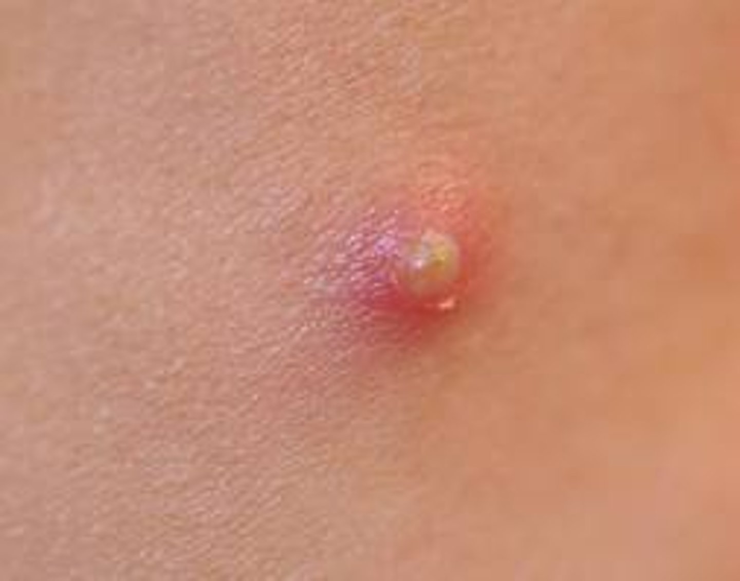 <p>small raised area of skin containing Pus (type of pimple)</p>