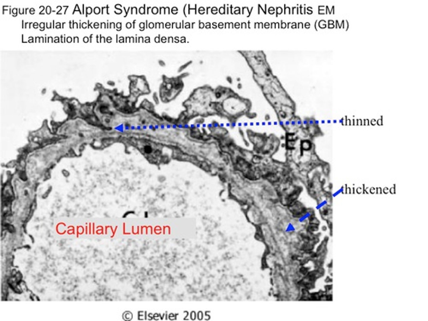 <p>Alport syndrome (mutation in collagen IV)</p><p>X-linked</p><p>Irregular thickening of GBM</p><p>Basket Weave (thinning) on EM</p><p>Isolated hematuria</p>