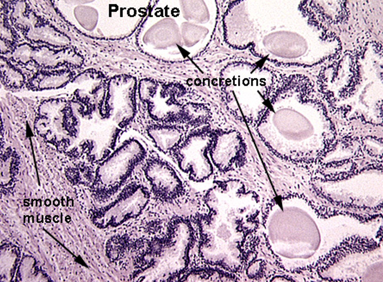 <p><strong>Prostate</strong></p><ul><li><p class=""><strong>Multiple secretory glands</strong></p></li><li><p class=""><strong>Corpora amylacea</strong> (round, eosinophilic concretions) often seen in gland lumens — the circles inside the lumen</p></li><li><p class="">Glands vary in size and shape</p></li></ul><p></p>