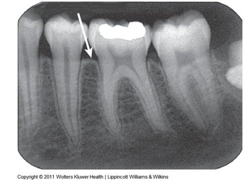 <p>Crestal Bone</p>