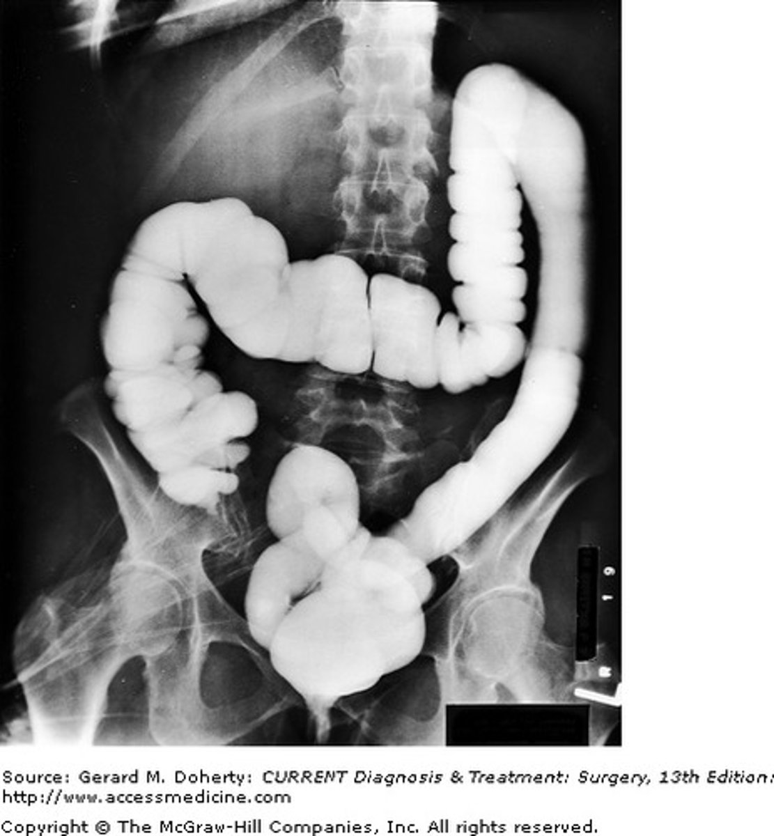 <p>Radiographic image of the large intestine</p>