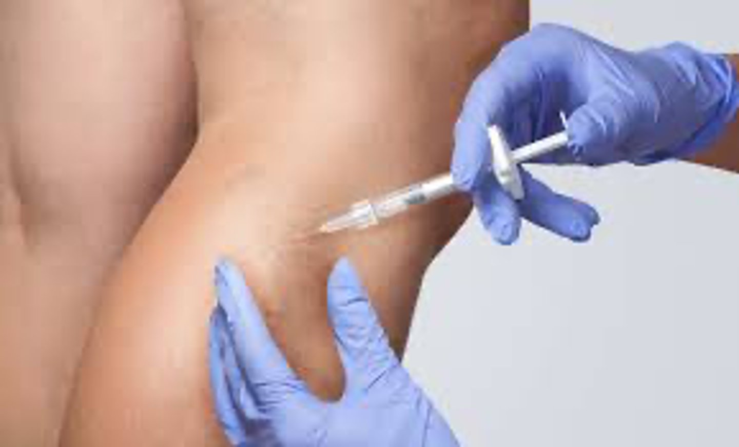 <p>Chemical injected directly into vein = obliteration</p>