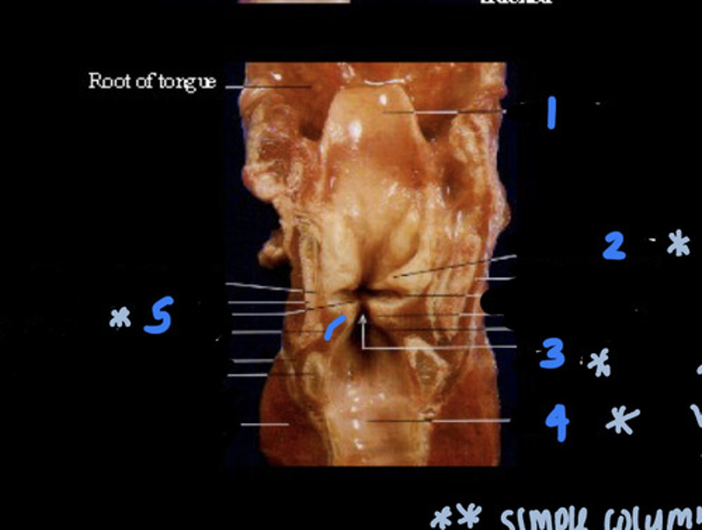 <p>Name the Opening Between #2 &amp; #5</p>
