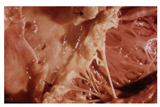 <p>usually secondary to BSI</p><p>high fever, heart murmur, emboli, non specific features (pain, weight loss), Osler’s nodes</p><p>clinicians must investigate for primary focus e.g. IV line site</p><p>treatment requires prolonged IV vancomycin and gentamycin</p><p></p>
