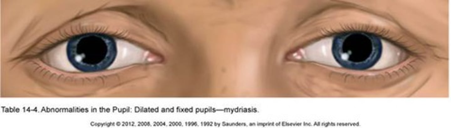 <p>Fixed and dilated pupils. May occur with sympathetic nerve stimulation, glaucoma, CNS damage or deep anesthesia.</p>