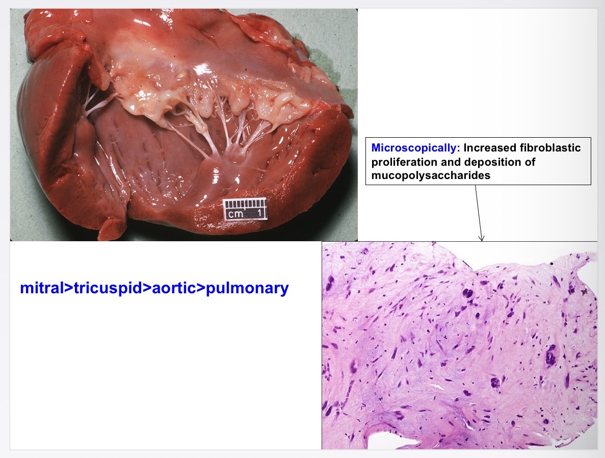 <p>inc fibroblastic proliferation, mucopolysaccharide deposition </p>