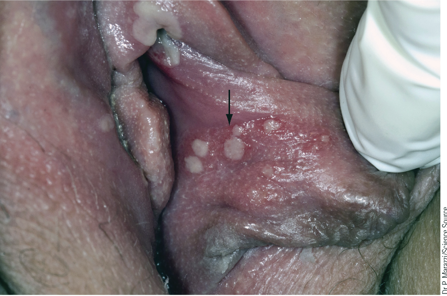 <p>Are often considered skin infections but they are also often sexually transmitted. Caused by HSV 1 and 2</p>