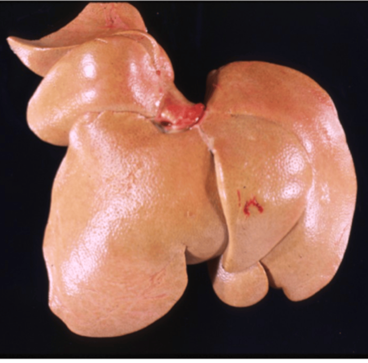 <p>- Enlarged, soft (friable), greasy, pale yellow liver</p><p>- Description of image: The liver is diffusely enlarged, soft, and pale tan/yellow. It has a greasy texture on cut surface.</p>