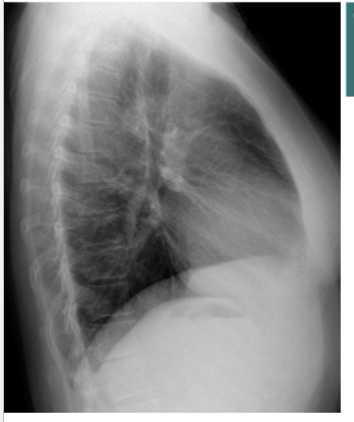 <p>Identify costophrenic angles (post + ant)</p>