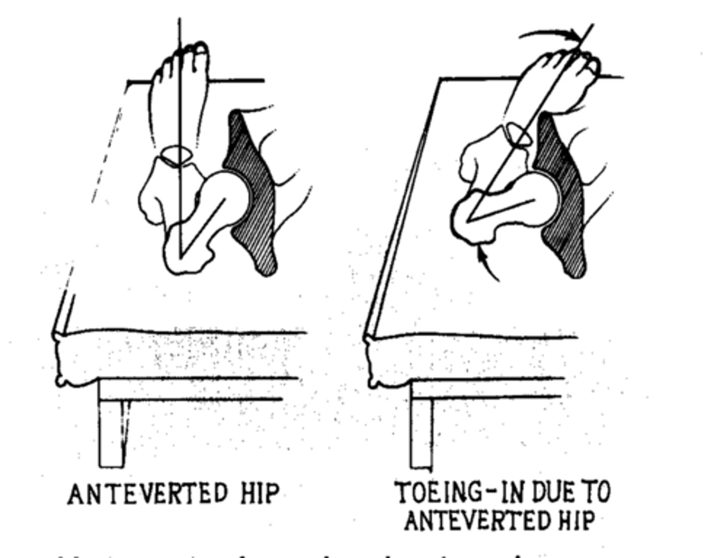 <p>angle of torsion is greater than 15 degrees</p><p>lacks ER</p><p>toe-in gait</p>