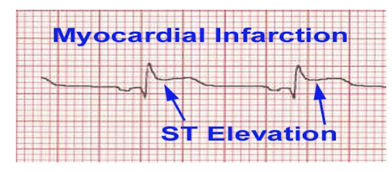 <ul><li><p>ST Segment Elevation = MYOCARDIAL INFARCTION</p><ul><li><p>Elevation Amount: > 1mm/1 small box</p><ul><li><p>Call 911 + Stop Exercise</p></li></ul></li><li><p>2 Characteristics:</p><ul><li><p>Complete occlusion of blood supply and cell death</p></li><li><p>ST segment elevation</p></li></ul></li></ul></li></ul><p></p><p>NOTE:</p><ul><li><p>ElevaTION = InfarctION</p></li></ul><p></p>