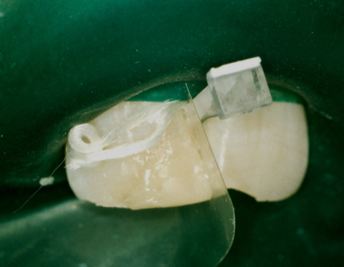 <p>composite - in the enamel shade is built up in excess&nbsp;</p>