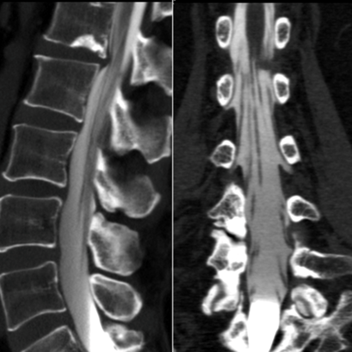 <p>It is non-invasive with no contrast, sequences are used for the CSF (spinal stenosis)</p>