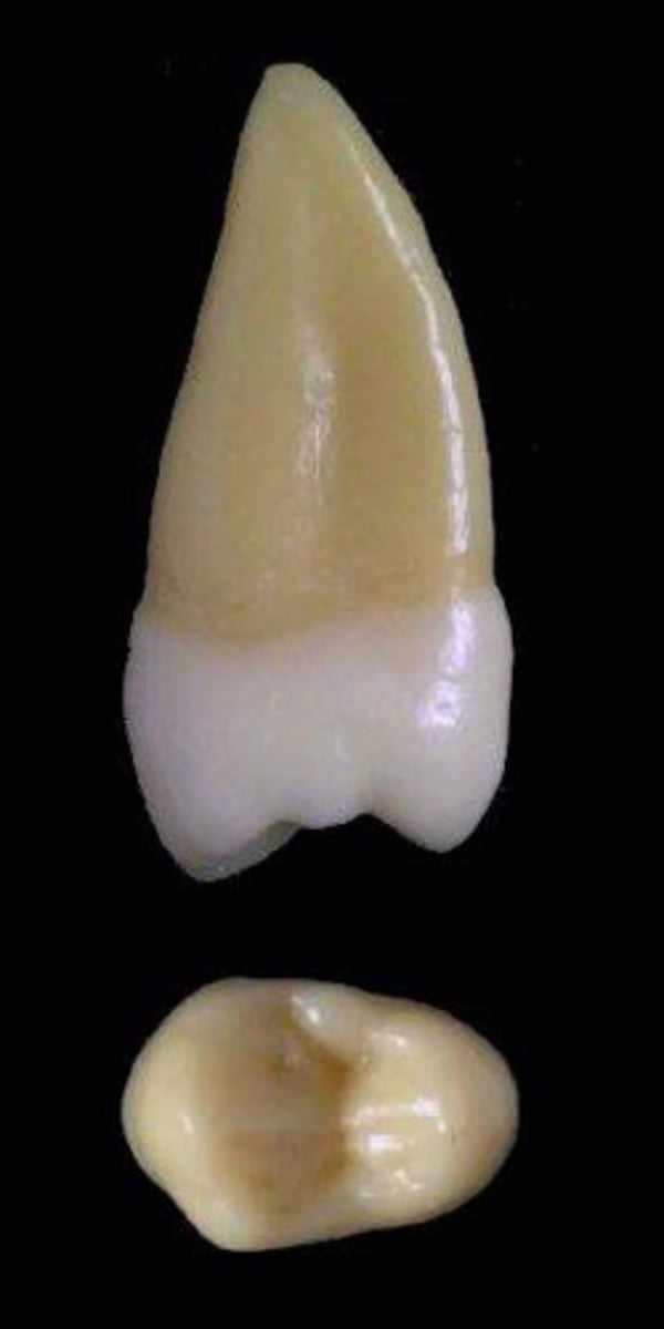 <p>what tooth is this &amp; why?</p>
