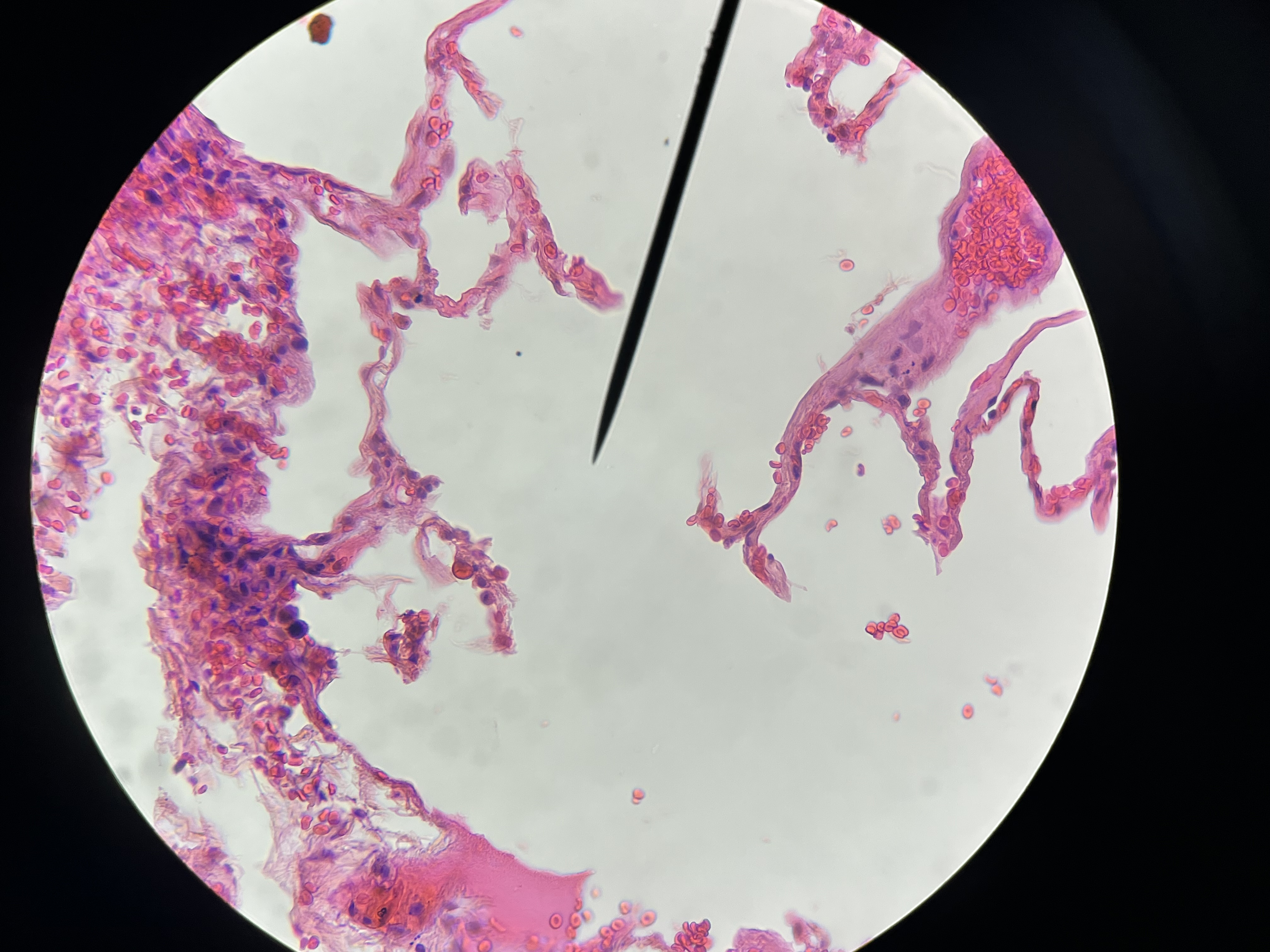 <p>Symptoms are Dyspnea, Cachexia, Tachypnea</p>