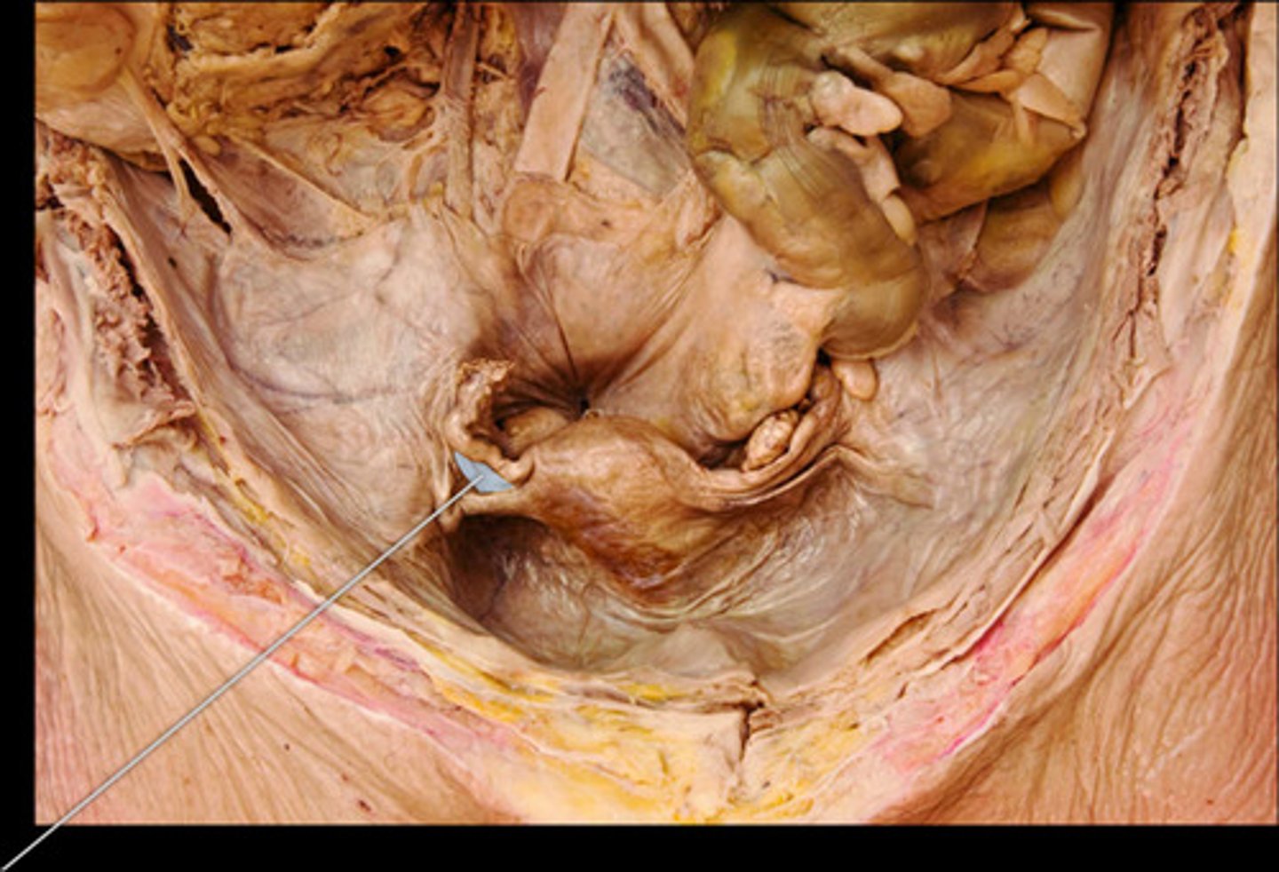 <p>right ovarian ligament</p>