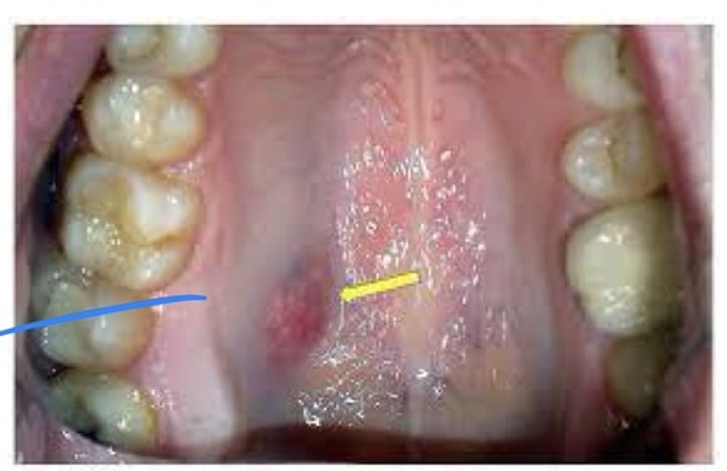 <p>A malignant salivary gland tumours. Unencapsulated, infiltrating tumour. Major gland tumours are most often found in the parotid gland, minor gland tumours on the palate. Appear clinically as slowly enlarging masses. May appear in the bone as wither a unilocular or multilocular radiolucency. May occur over a wide age range. Usually in adults but most common malignant salivary tumour in children, occurs most often in females.</p>