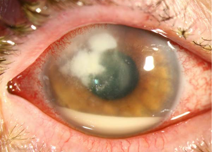 fungal keratitis
