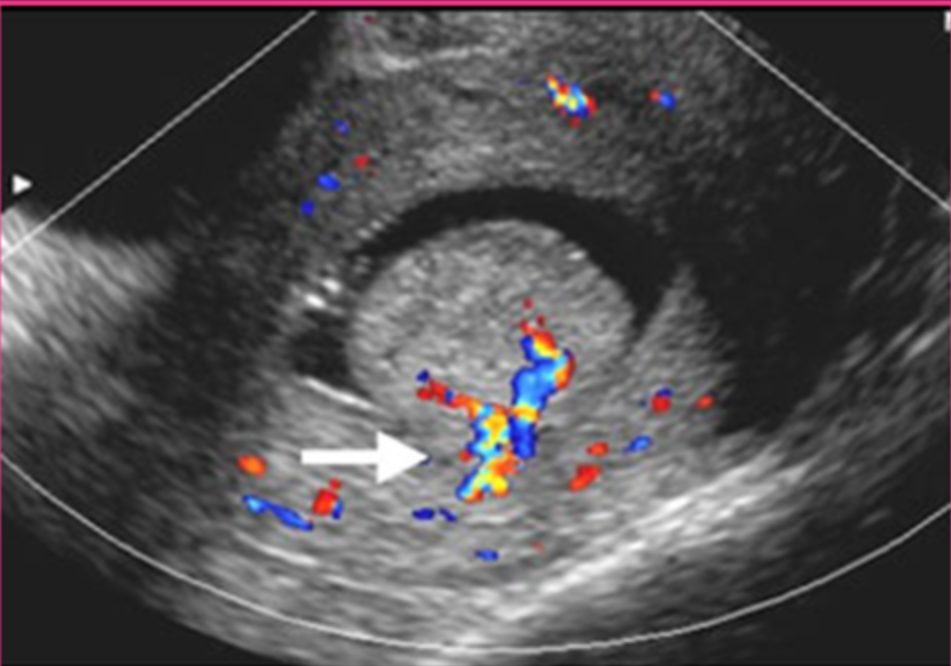 <p>What is the sonographic appearance of endometrial polyps?</p>