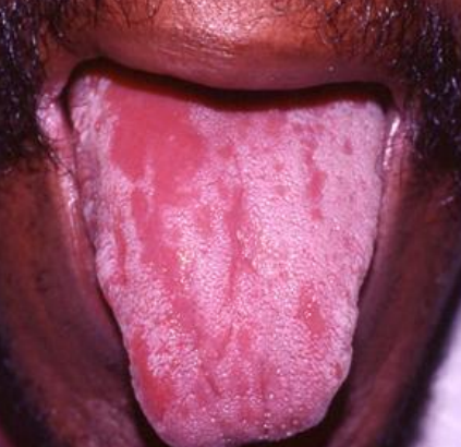 Oral candidiasis