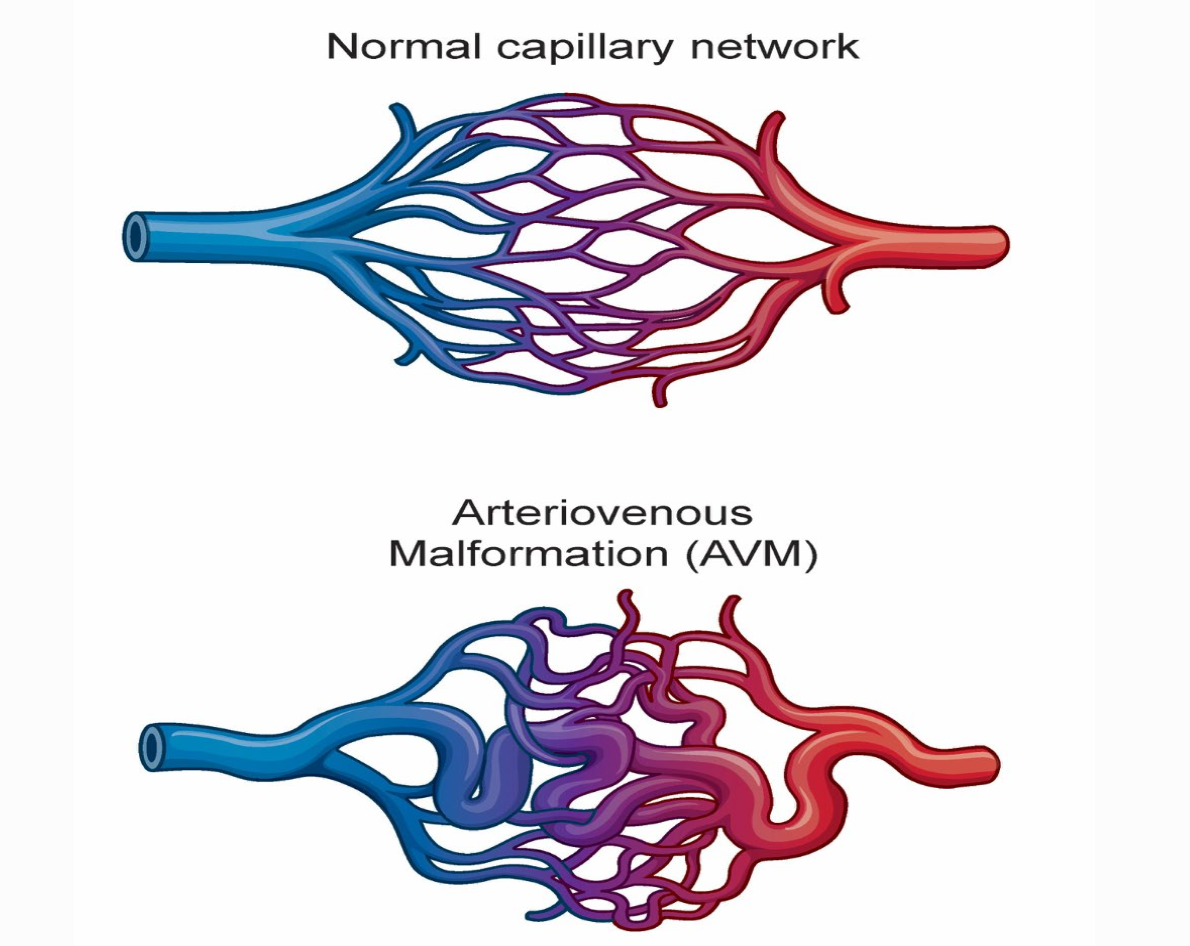 <p>arteriovenous malformation (AVM) </p>