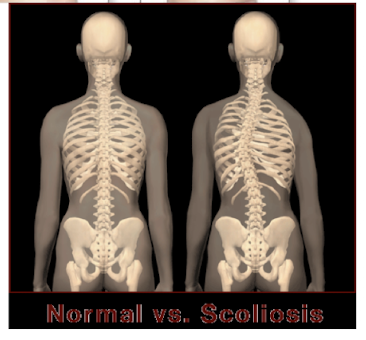 <p><strong>Scoliosis</strong> = <strong>lateral (side-to-side)</strong> curvature of the spine.<br>Occurs in the <strong>frontal (coronal) plane</strong>.</p>