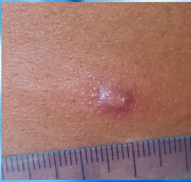 <p>Very small palpable lesions raised above the skin </p><p>Longest diameter is less than 1 cm</p>