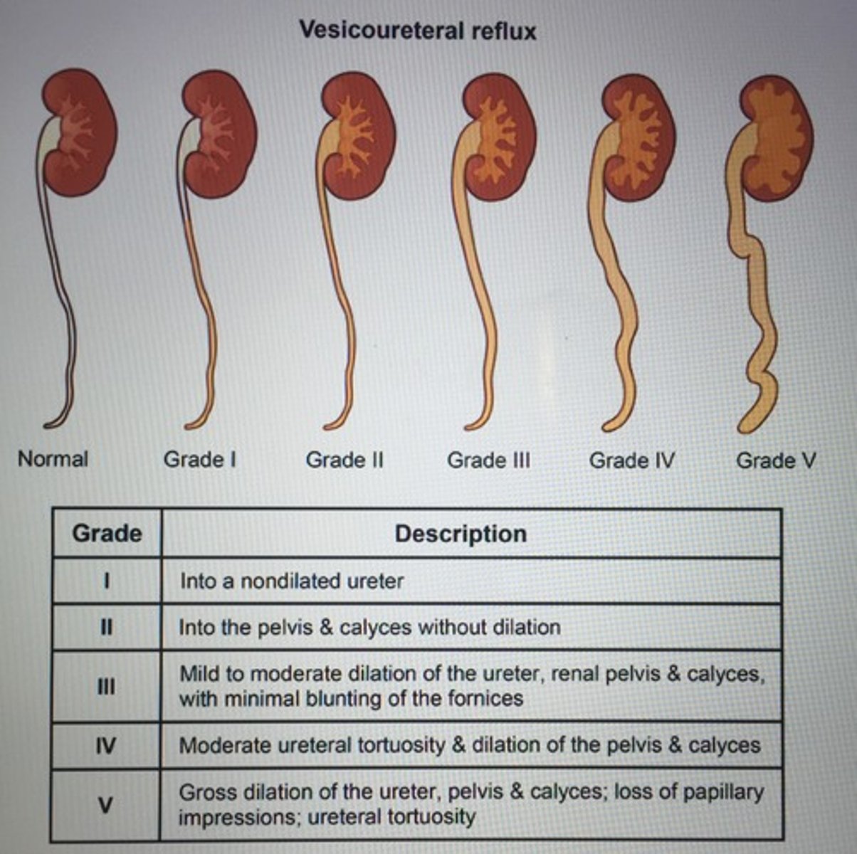 <p>Vesicoureteral reflux (VUR)</p><p>- Contrast voiding cytourethrogram</p><p>- Renal US to screen hydronephrosis</p>