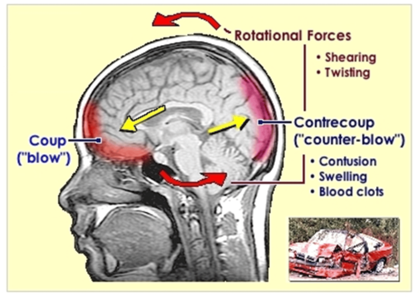 <p>Acceleration-deceleration injury</p>