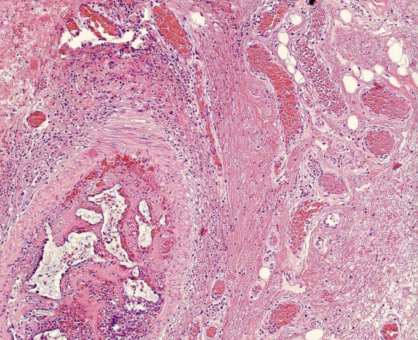<p>what are histopathologic features of Central Vascular Malformation?</p>