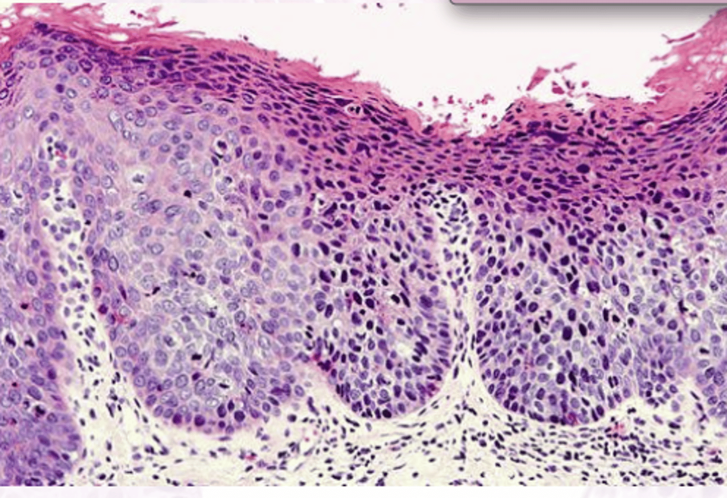 <p>Full thickness dysplasia, NO invasion</p>