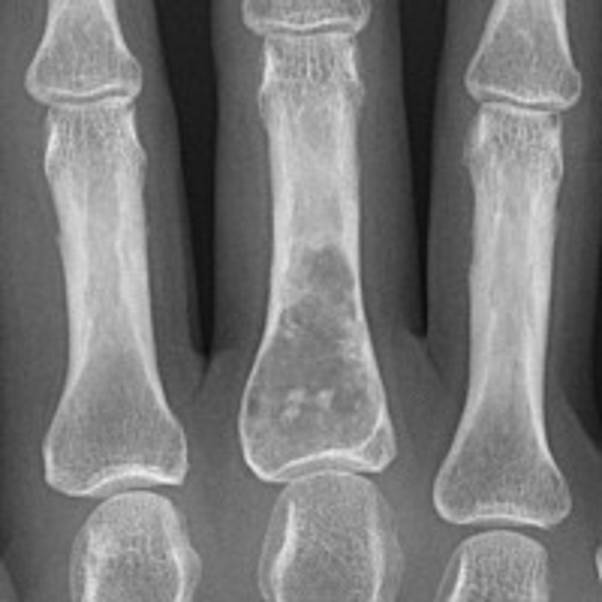 <p>lucent in hands/fingers</p><p>matrix calcification of long bones</p><p>metaphysis of long bones</p>