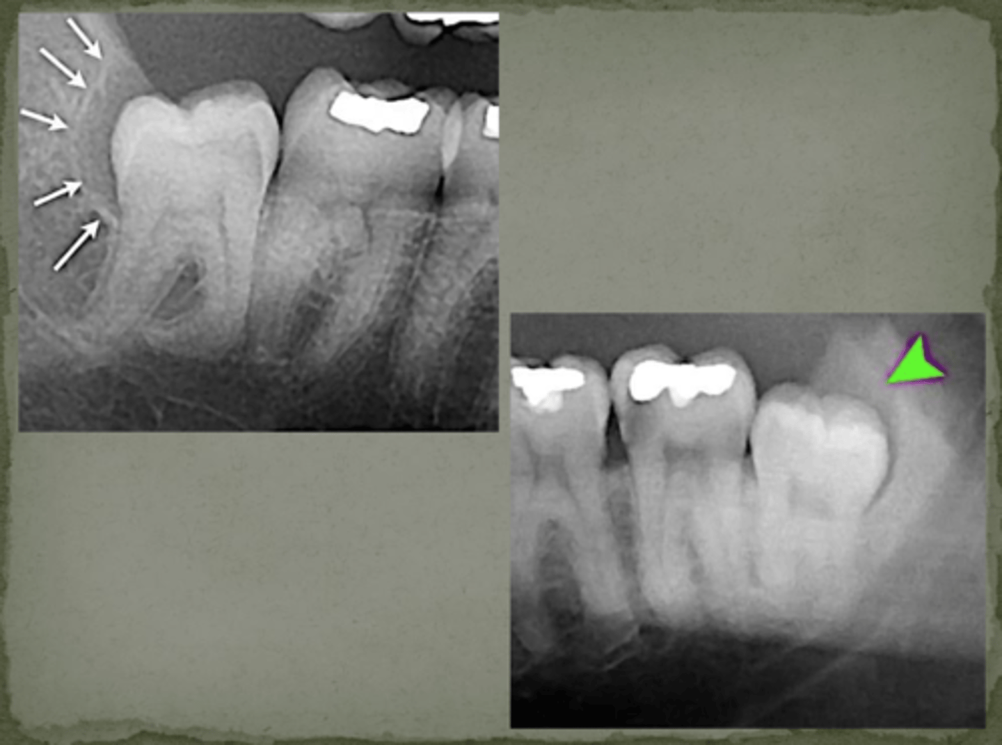 <p>Loss of cortical outline</p>
