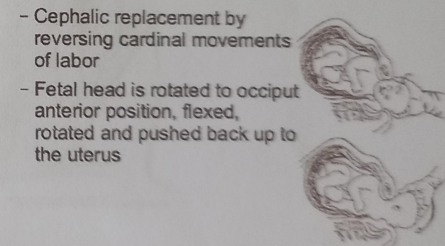 <p>involves pushing back the delivered fetal head into the birth canal in anticipation of performing a cesarean section in cases of shoulder dystocia</p>