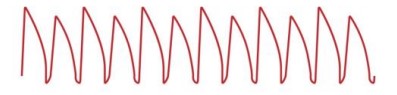 <p>What is <strong>ventricular fibrillation</strong>?</p>