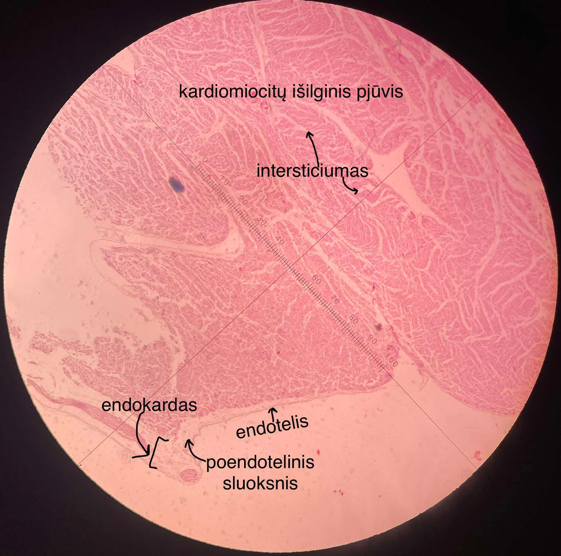 <p>38A. Širdies sienelė</p><p>Visą širdį dengia perikardo dangalas (širdiplėvė/parietalinis perikardas). Jis sudarytas iš plokščio mezotelio (širdies pusėje) ir po mezoteliu esančių kolageninių ir elastinių skaidulų sluoksnių. Ten randamos kraujagyslės, limfagyslės, nervai.</p><p>Perikardo ertmė - tarpas tarp parietalinio (širdiplėvės) ir visceralinio (epikardo) perikardo sluoksnių. Joje nedaug serozinio skysčio, drėkina širdies paviršių ir leidžia jai laisvai judėti.</p><p>Širdies sienelė:</p><ol><li><p>EPIKARDAS (visceralinis perikardas) - serozinis dangalas, padengtas vienasluoksnių plokščių MEZOTELIO ląstelių, po jomis POMEZOTELINIS SLUOKSNIS (j.a su daug kolageno skaidulų). Po juo tęsiasi POEPIKARDINIS SLUOKSNIS (iš puraus j.a su kraujagyslėm, nervais ir riebaliniu sluoksniu (adipocitais).</p></li><li><p>MIOKARDAS - storiausias sluoksnis. Sudarytas iš ruožuotojo širdies raumens - KARDIOMIOCITŲ ir INTERSTICIUMO (j.a, užpildantis tarpus tarp kardiomiocitų, jame yra praeinančios kraujagyslės, fibroblastocitai, makrofagocitai). Miokarde daugiausiai rrandama fibroblastocitų, tada kardiomiocitų (kartu sudaro 90%). Pažaidos metu atsiranda MIOFIBROBLASTOCITAI, kurie gamina tarpląstelinę medžiagą.</p><ol><li><p>Kontraktiliniai (darbiniai) - ruožuotos ląst., su pailgais 1-2 branduoliais. Sujungti įterptiniais diskais, šakoti, jungiasi ir galais ir šonais.</p></li><li><p>Turintys endokrininių savybių - randami prieširdžiuose (daugiausiai dešiniajame), išskiria Na uretinį peptidą.</p></li><li><p>Modifikuoti - širdies laidžiojoje sistemoje.</p></li></ol></li><li><p>ENDOKARDAS - iš vidaus iškloja širdies kameras, formuoja vožtuvus. Jį dengia vienasluoksnis plokščiasis epitelis - ENDOTELIS, kuris remiasi į pm, už kurios POENDOTELINIS SLUOKSNIS (purus j.a su kolageninėm skaidulom), RAUMENINIS - ELASTINIS SLUOKSNIS, POENDOKARDINIS SLUOKSNIS (yra venų, nervų, Purkinė ląst, atskiria endokardą nuo miokardo).</p></li></ol><p></p>