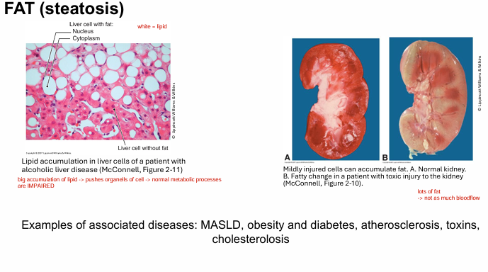 <p><span style="color: yellow"><strong>FAT (steatosis)</strong></span></p><ul><li><p>obsesity/diabetes</p></li><li><p>atheroscleorsis</p></li></ul><p></p><p>Fat accumulation → pushes organelles → normal metabolic processes impaired</p><ul><li><p>lots of fat, not a lot of blood flow to these organs (therefore no O2/nutrients)</p></li></ul><p></p><p>Other substances that accumulate:</p><ul><li><p>glycogen, proteins</p></li></ul><p></p>