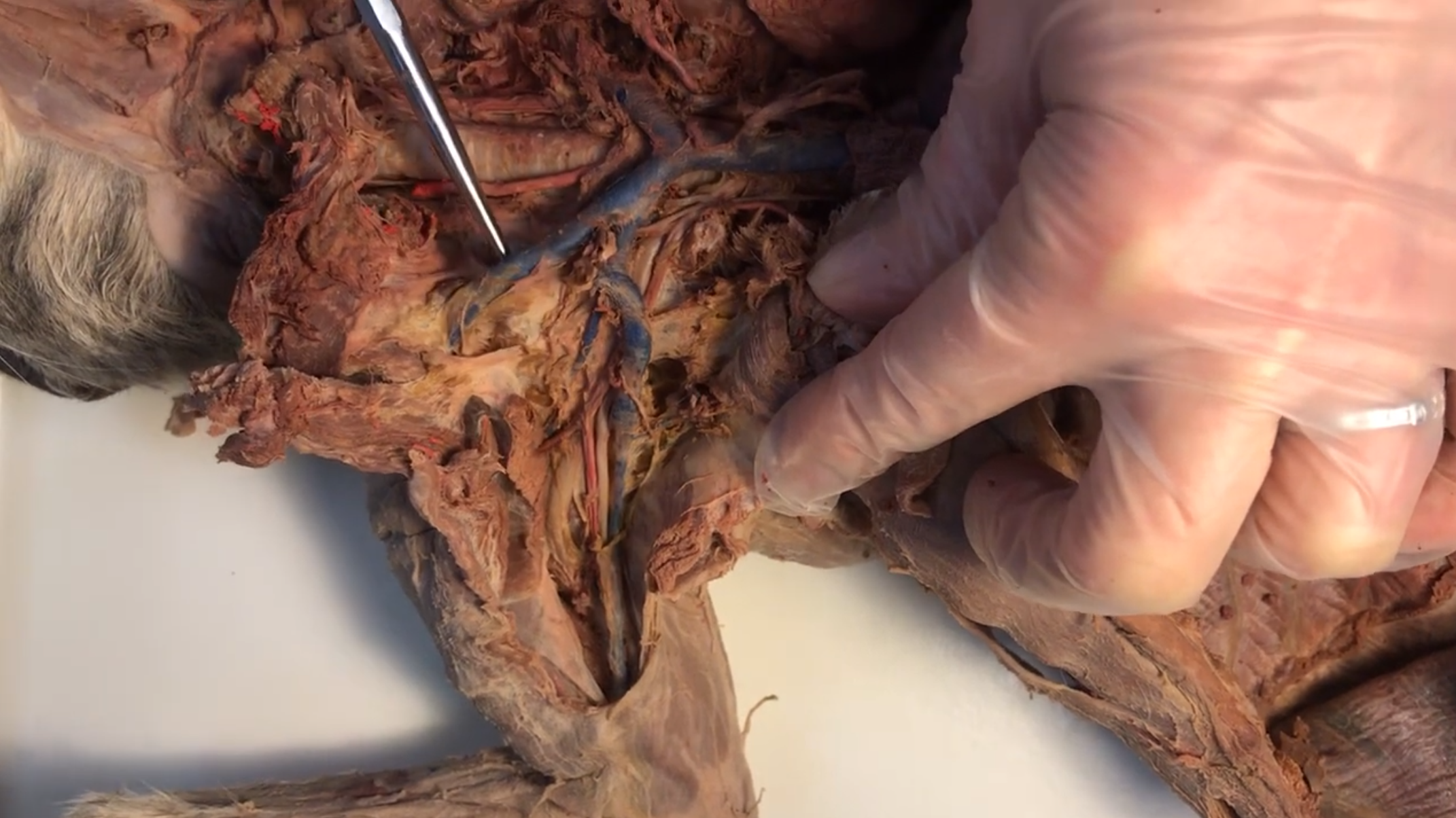 <p>What vein is this</p>