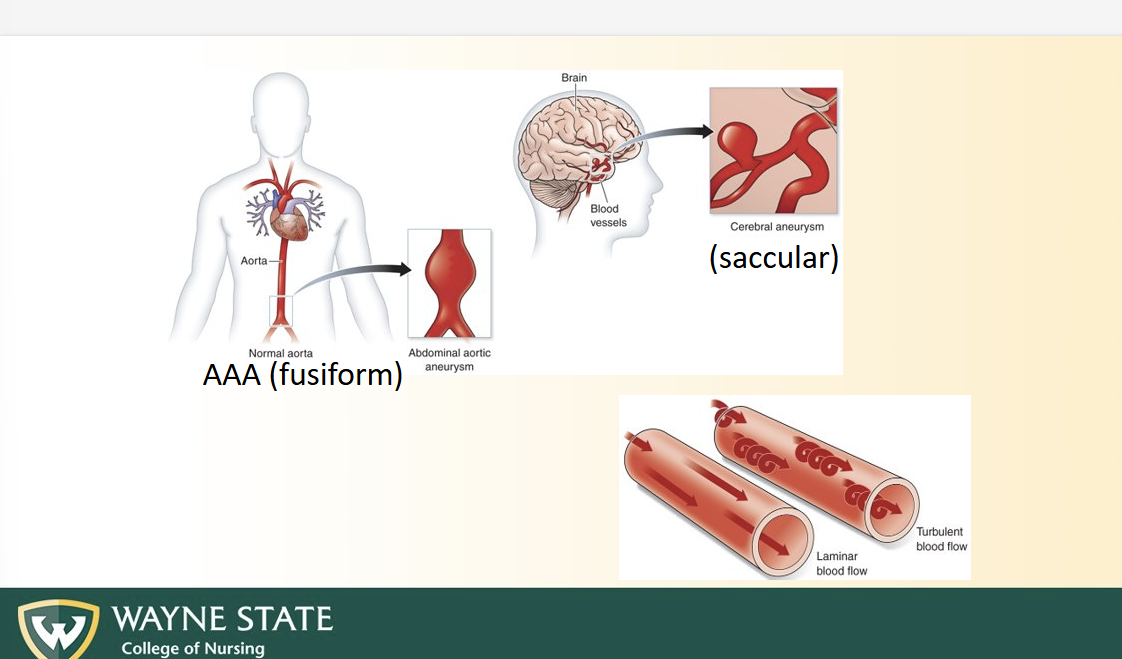 <ul><li><p>AAA/ fusiform = buldge of an artery</p></li><li><p>Saccular = sac coming off of blood vessel</p></li></ul><p></p>