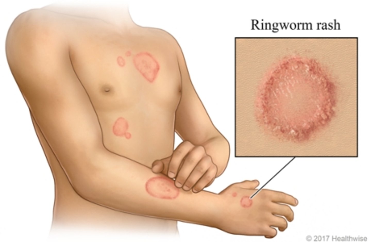 <p>- not itchy</p><p>- can be anywhere besides elbows and knees</p><p>- circular 'ring' with raised borders and a clear centre</p>