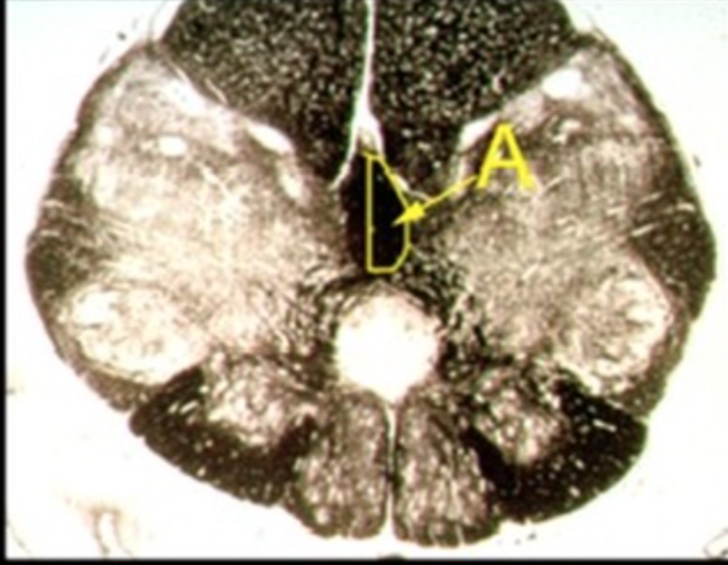 <p>Describe the signs/symptoms you will see if structure "A" is lesioned.</p>
