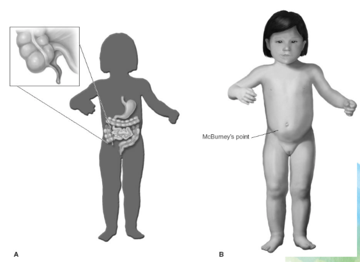 <p><strong>Symptoms:</strong> Vague abdominal pain<strong> localized to the RLQ</strong>, nausea and vomiting, small-volume and frequent stools, fever, ill appearance. Maximal tenderness over McBurney’s point in the RLQ and tenderness/distention.<strong> If pain suddenly and temporarily stops, </strong>this is an indication the appendix has perforated. </p>